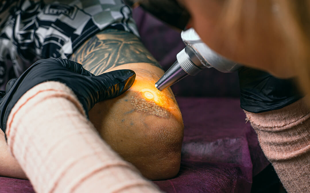 A professional removing a tattoo from someone's elbow.
