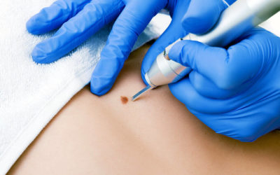 Top 4 Benefits of Cryosurgery in Dermatology