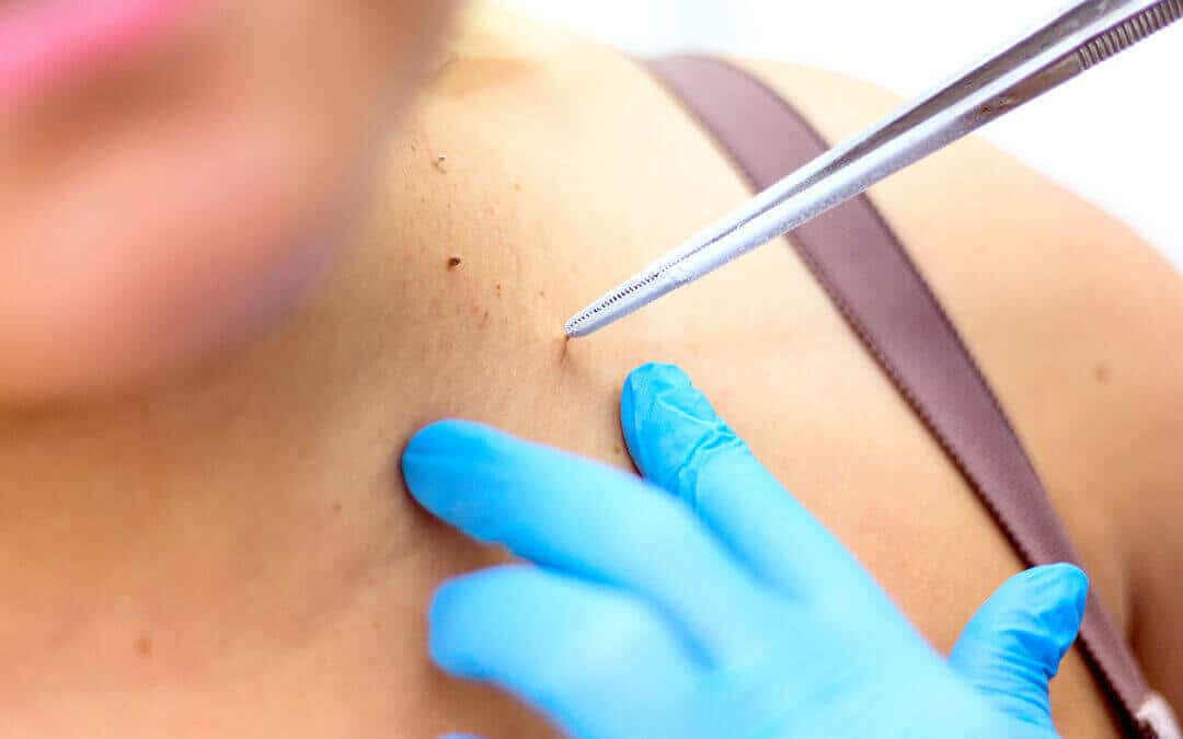 Cryosurgery to remove a skin tag