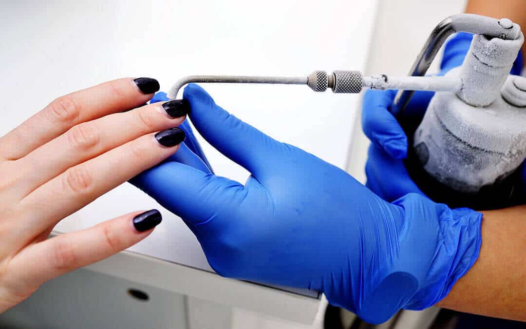 Cryosurgery to remove a wart