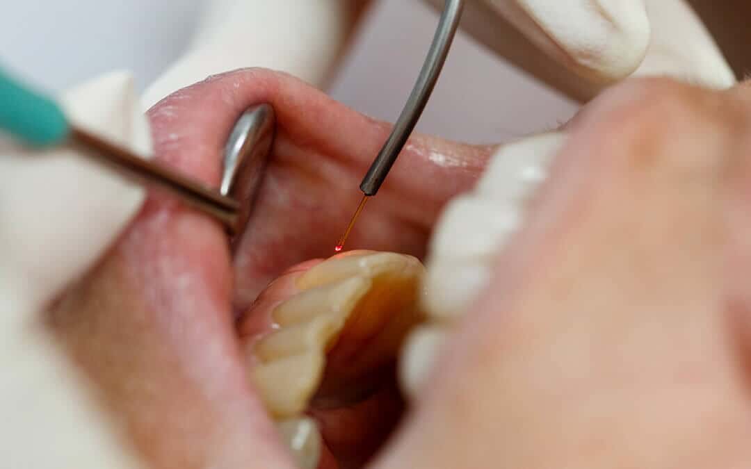CO2 Lasers in Dentistry - dentistry tools in person's mouth