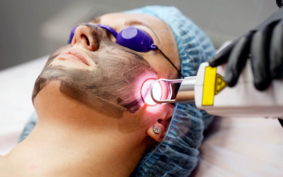 Laser resurfacing on woman's face