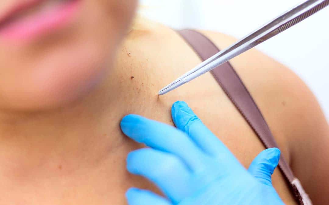 Skin Tag Removal Cryosurgery